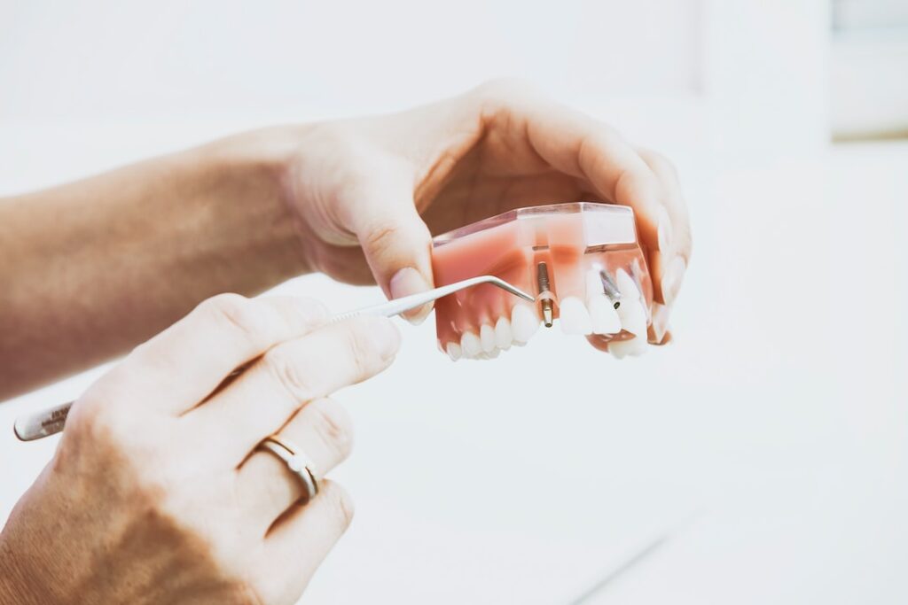 Wszystko o implantach zębowych