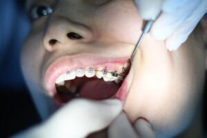 Skąd się biorą krzywe zęby